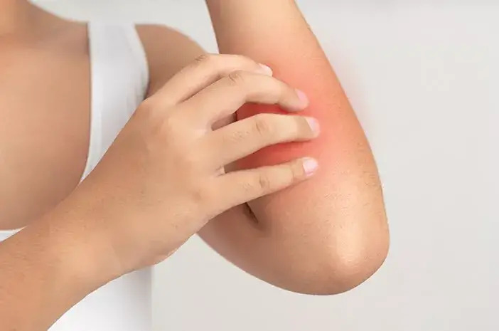 Ini Penyebab Bintik Merah pada Kulit dan Cara Mengatasinya